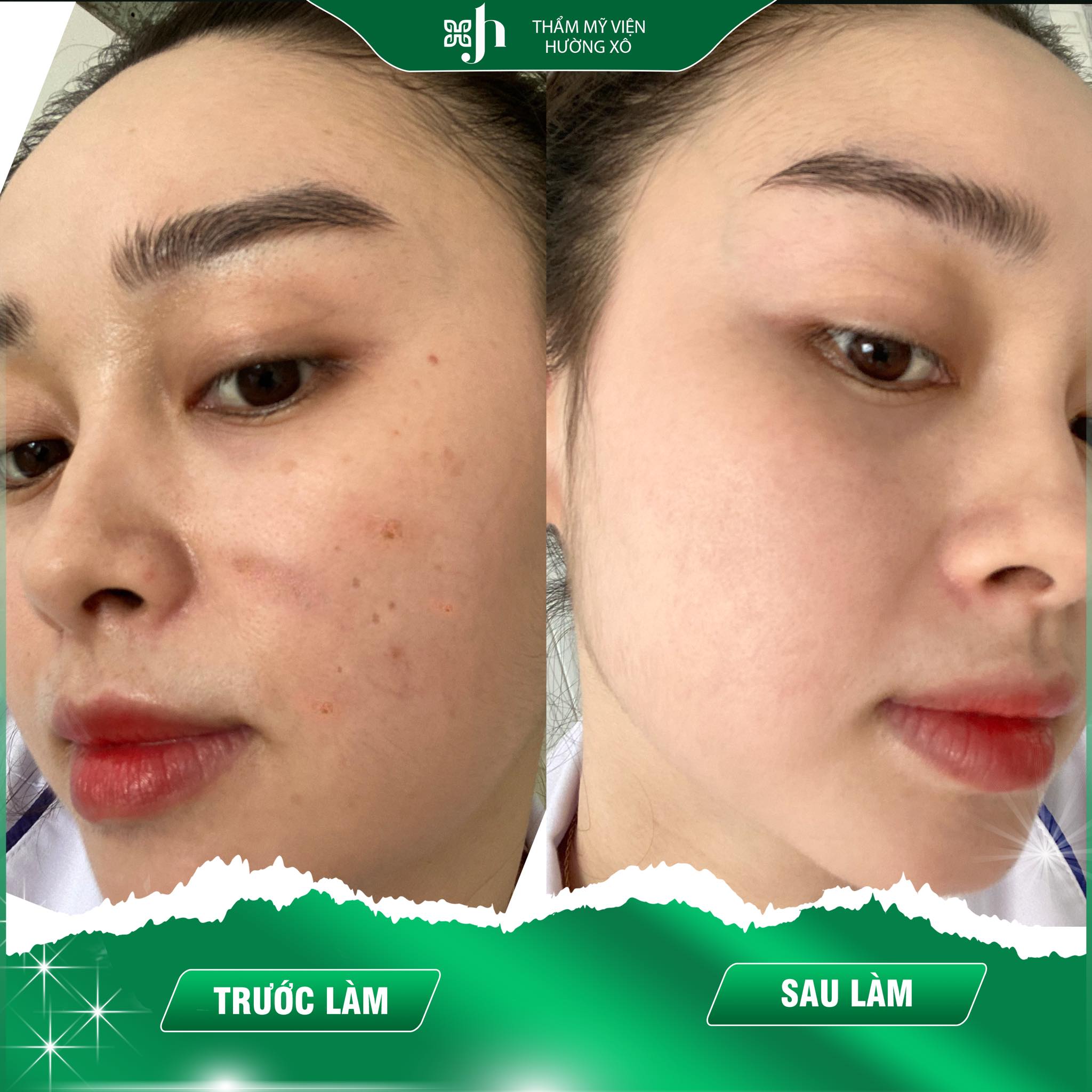 Địa Chỉ Điều Trị Thâm Mụn Uy Tín Tại Hà Tĩnh