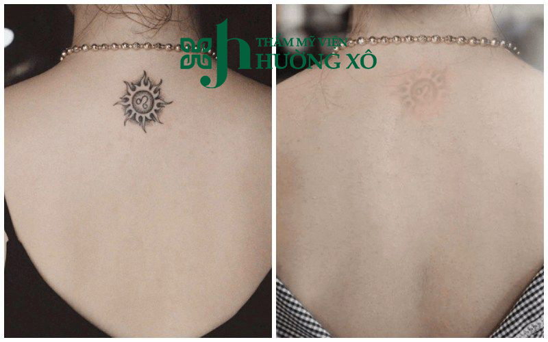 Địa Chỉ Xoá Xăm Uy Tín Tại Vinh, Nghệ An