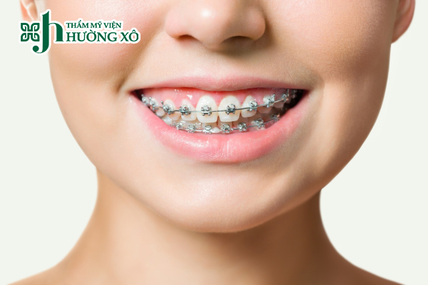 Dịch Vụ Niềng Răng Uy Tín Tại Hà Tĩnh