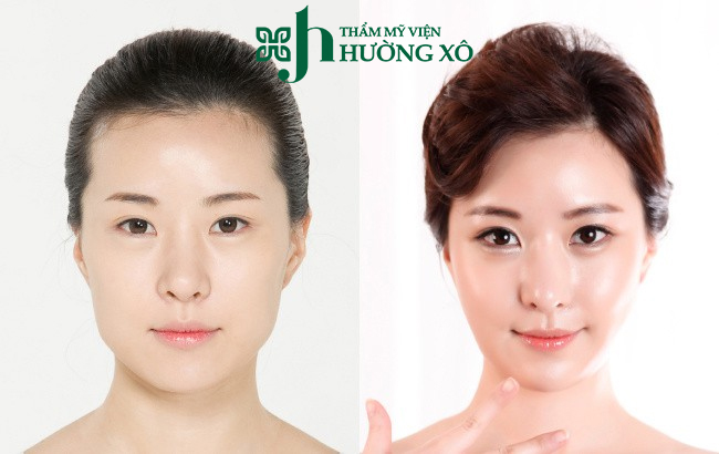 Dịch Vụ Độn Cằm V Line Uy Tín Tại Vinh, Nghệ An