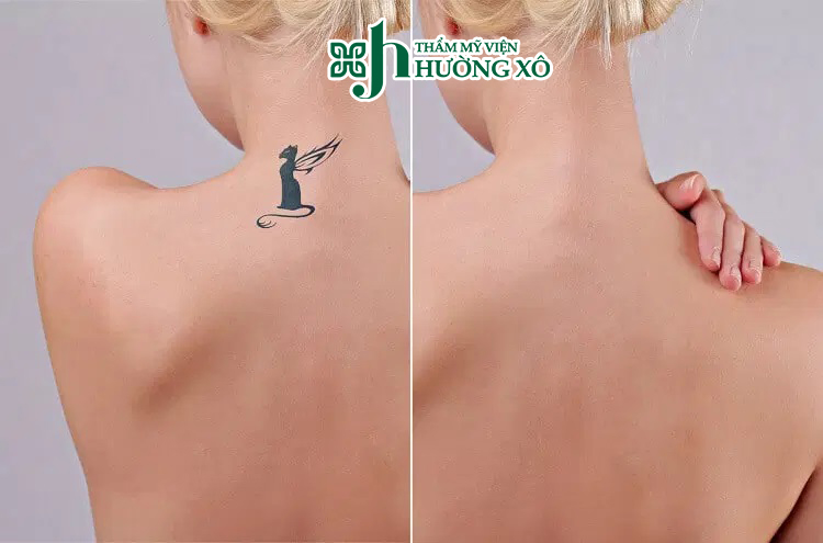 Đơn Vị Cung Cấp Dịch Vụ Xoá Xăm Uy Tín Tại Hà Tĩnh