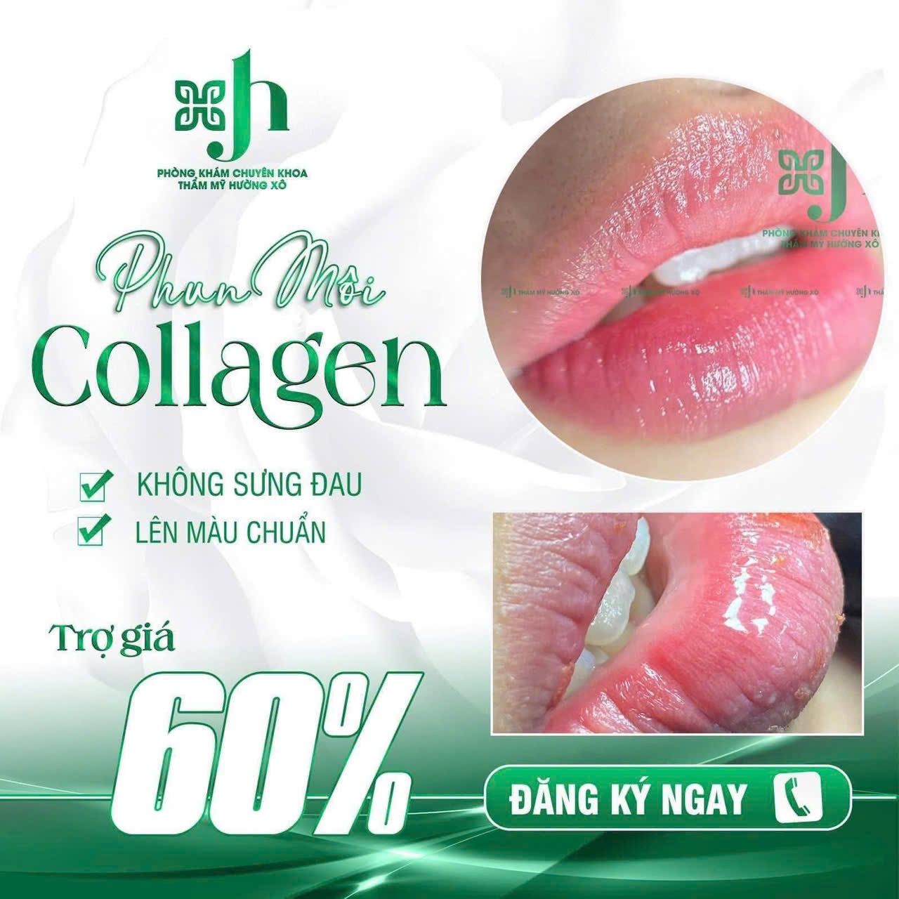 Dịch Vụ Phun Môi Collagen Uy Tín Tại Hà Tĩnh
