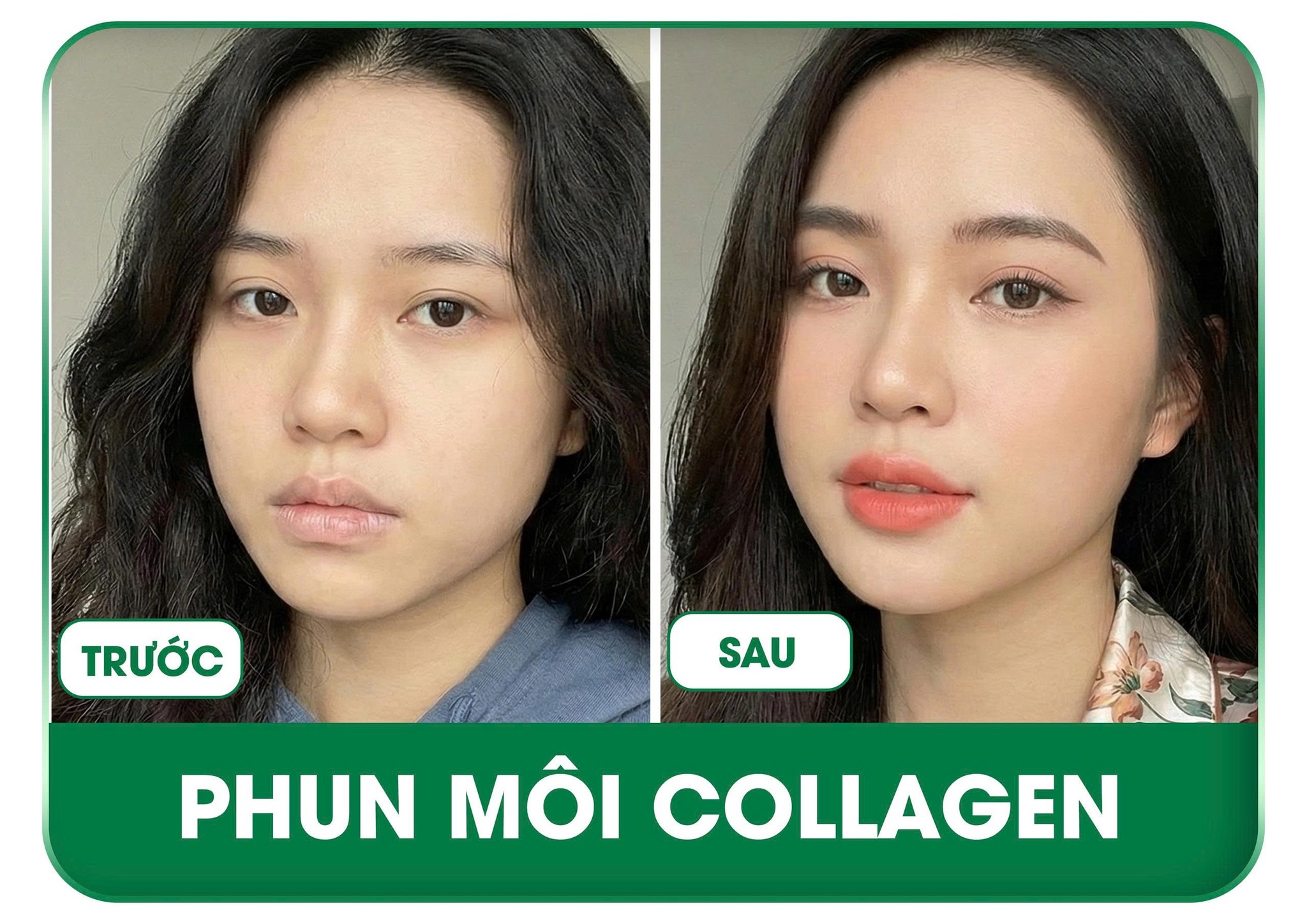 Địa Chỉ Phun Môi Collagen Uy Tín Tại Vinh, Nghệ An