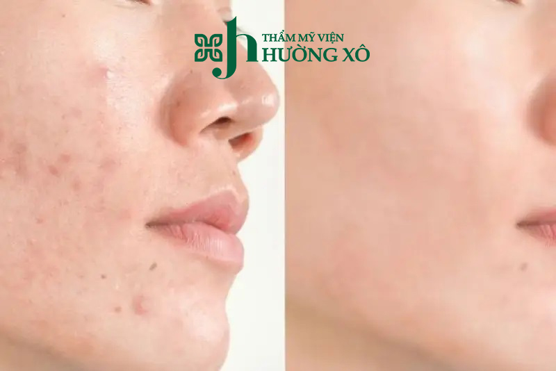 Tư Vấn Dịch Vụ Điều Trị Thâm Mụn Uy Tín Tại Vinh, Nghệ An