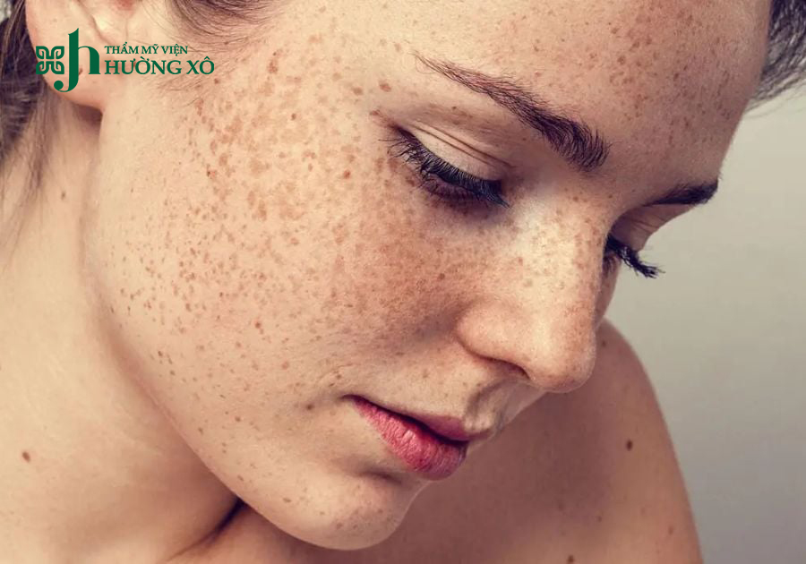 Dịch Vụ Điều Trị Nám Da Uy Tín Tại Hà Tĩnh