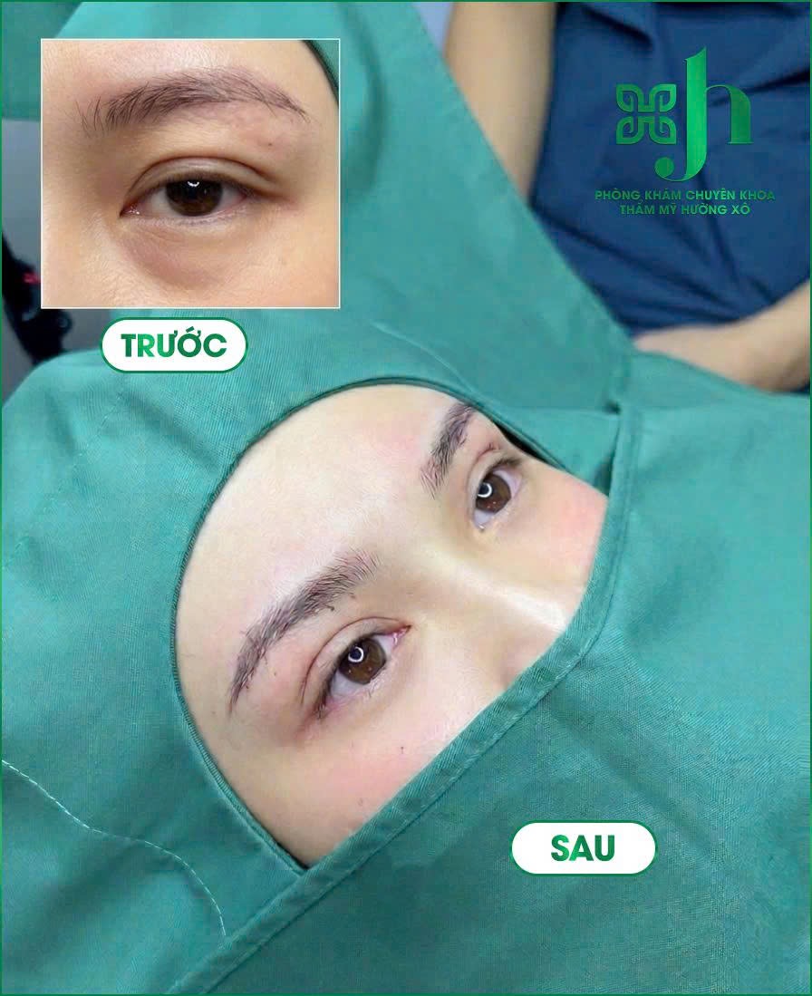 Dịch Vụ Nâng Cung Mày Uy Tín Tại Vinh, Nghệ An