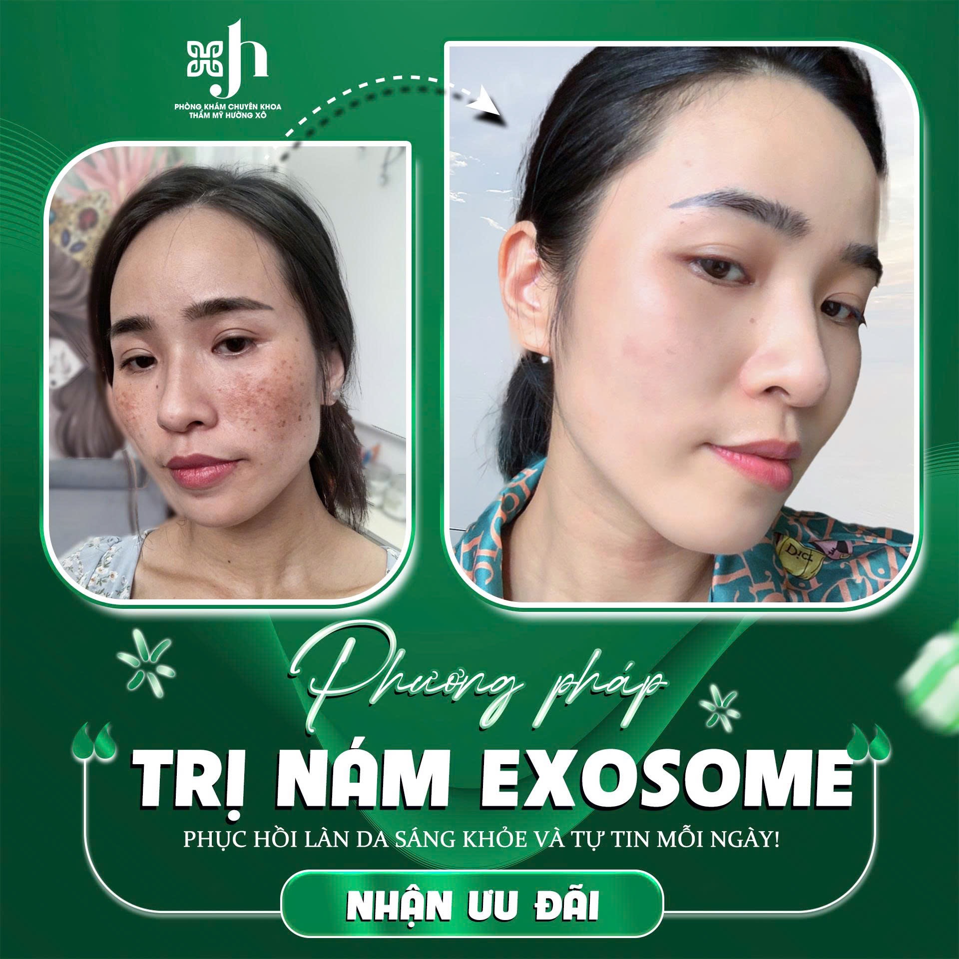 Địa Chỉ Điều Trị Nám Da Uy Tín Tại Hà Tĩnh