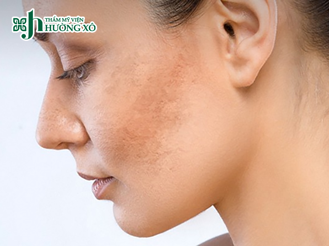 Địa Chỉ Điều Trị Nám Da Uy Tín Tại Nghệ An