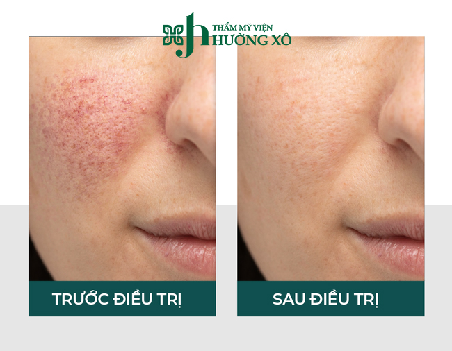 Địa Chỉ Điều Trị Tàn Nhang Uy Tín Tại Nghệ An