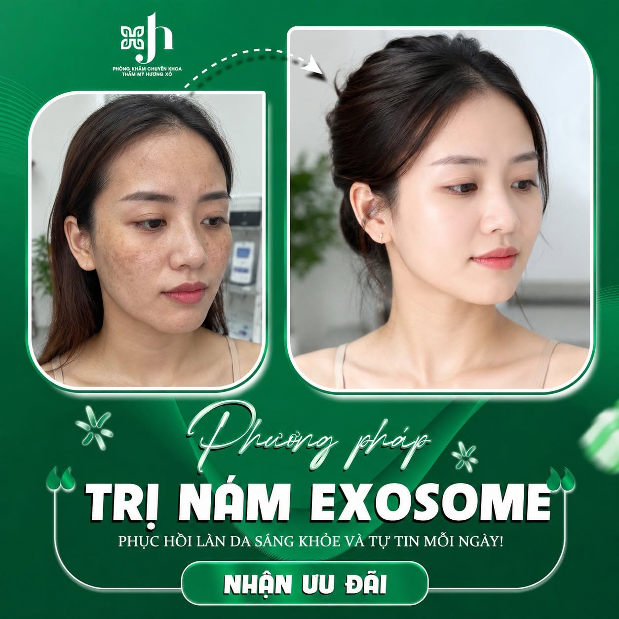 Cung Cấp Dịch Vụ Điều Trị Nám Uy Tín Tại Nghệ An