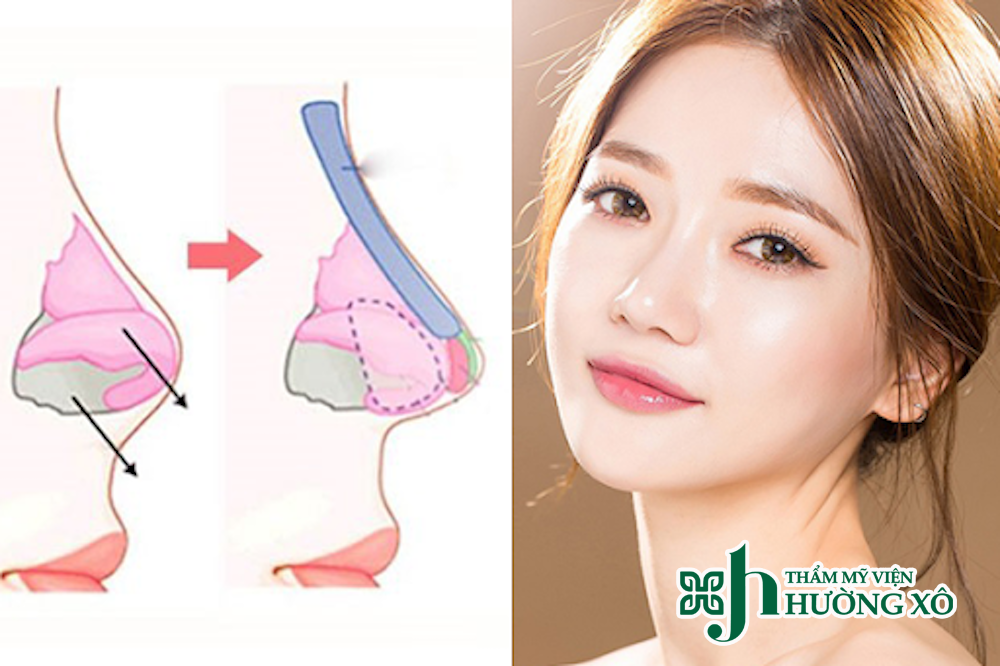 Dịch Vụ Nâng Mũi Bọc Sụn Uy Tín Tại Nghệ An