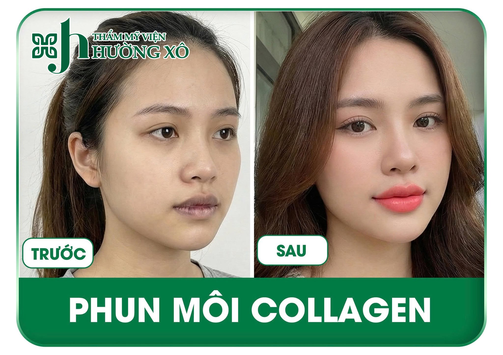 Dịch Vụ Phun Môi Collagen Uy Tín Tại Nghệ An