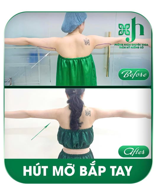 Địa Chỉ Hút Mỡ Bắp Tay Tại Hà Tĩnh