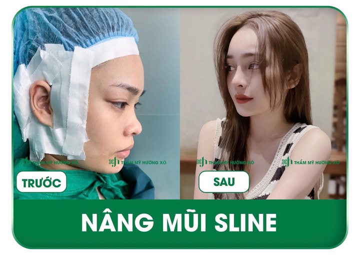Phẫu Thuật Nâng Mũi S Line Uy Tín Tại Vinh