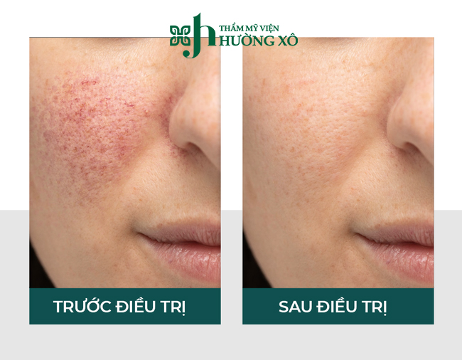 Phương Pháp Điều Trị Nám Uy Tín Tại Vinh