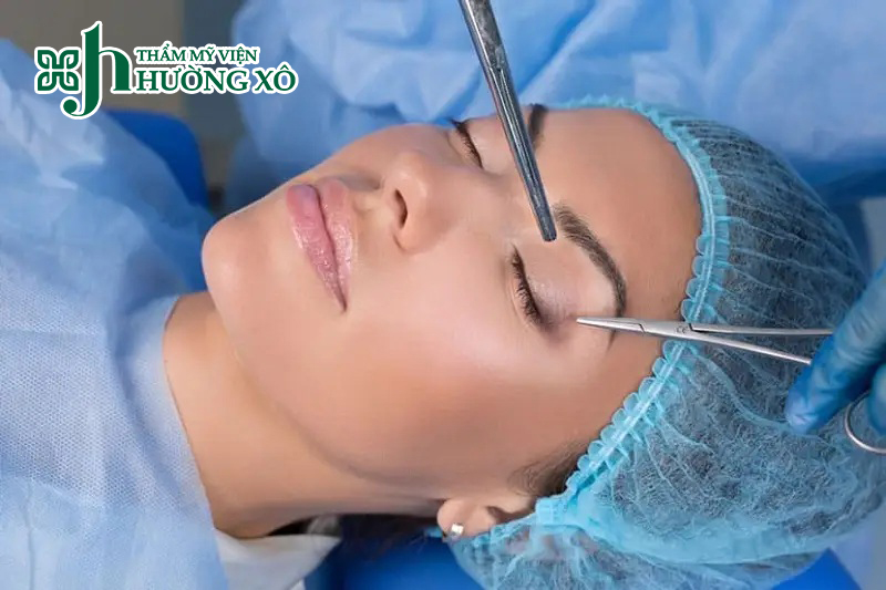 Thẩm Mỹ Hường Xô Cung Cấp Dịch Vụ Cắt Mí Nội Soi Tại Vinh