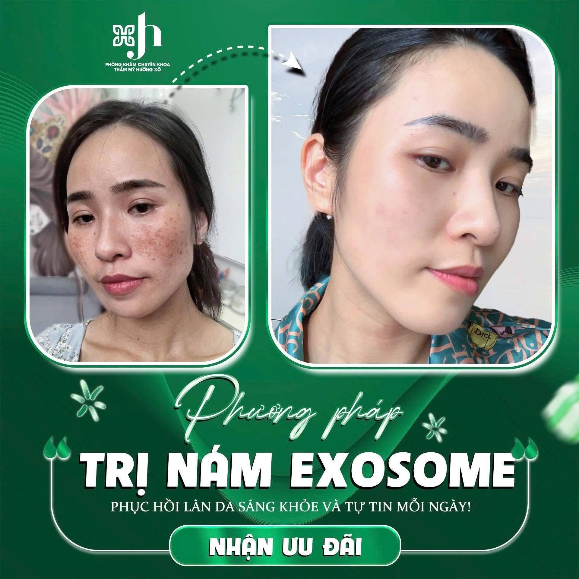 Dịch Vụ Điều Trị Nám Uy Tín Tại Hà Tĩnh