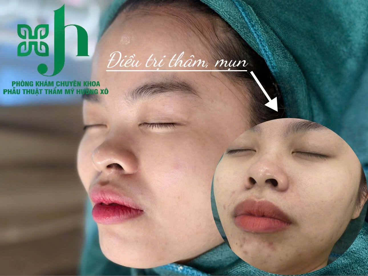 Điều Trị Thâm Mụn Uy Tín Tại Nghệ An