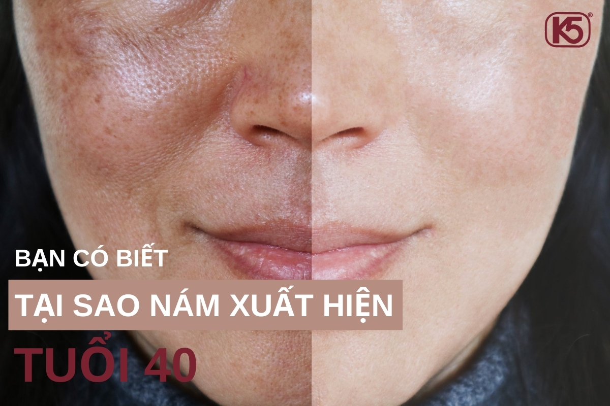 BẠN CÓ BIẾT TẠI SAO XUẤT HIỆN NÁM TUỔI 40