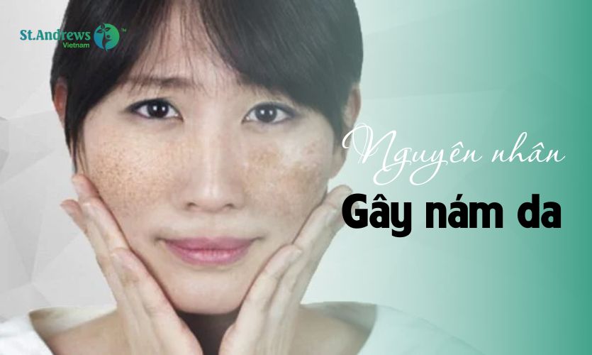 Đâu là nguyên nhân gây nám da nhiều người mắc phải