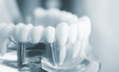 Trồng răng Implant