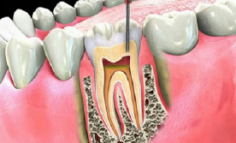 Điều trị tủy