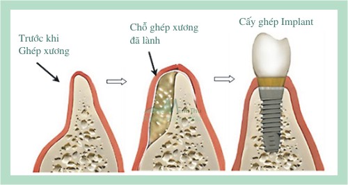 Cấy ghép xương nhân tạo là gì? Khi nào dùng để trồng răng Implant