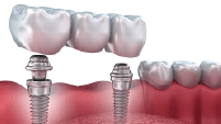 Quy trình trồng Implant