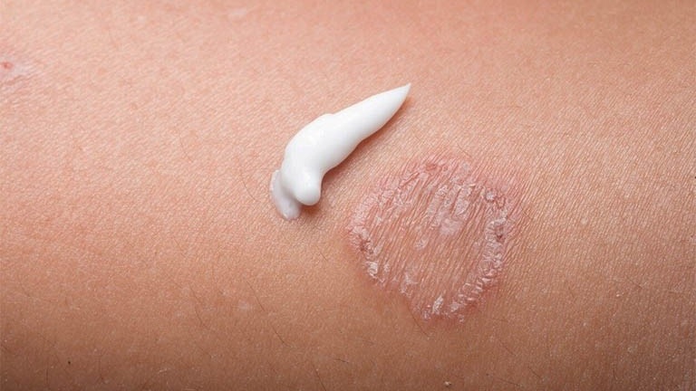 Tham khảo các loại thuốc trị lác đồng tiền hiệu quả