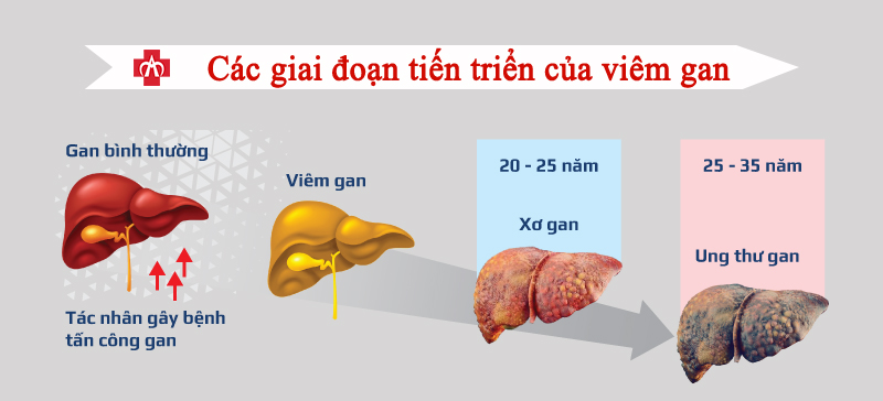 Các diễn biến và biến chứng của bệnh viêm gan B