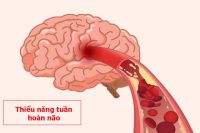 Thiểu năng tuần hoàn não và những vấn đề xung quanh