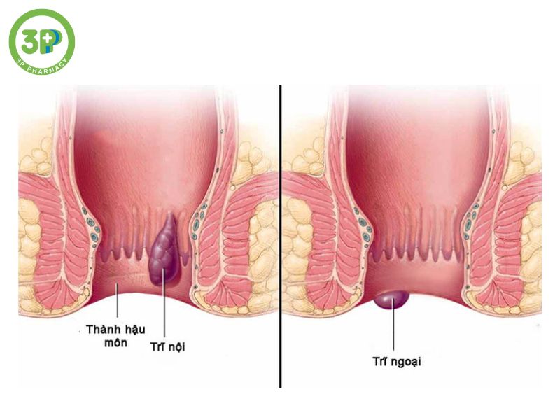 Khái quát về bệnh trĩ: Nguyên nhân, dấu hiệu, cách điều trị hiệu quả