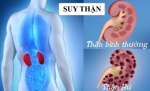 Bác sĩ Nhật mách 4 bài tập giúp cải thiện chức năng thận chỉ trong 6 tuần