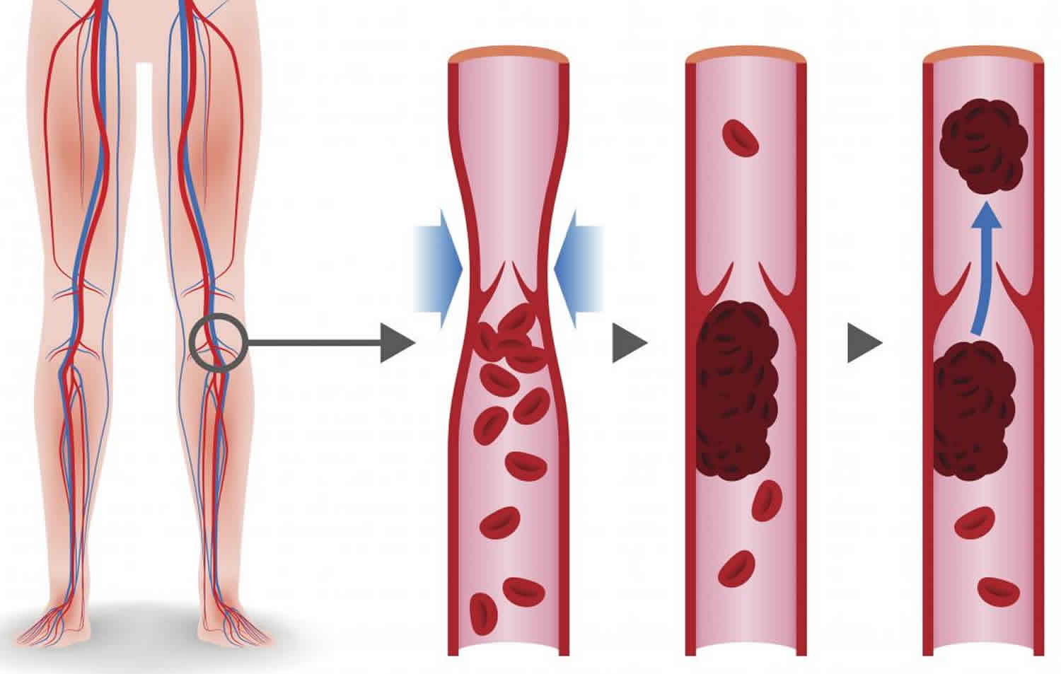 7 dấu hiệu cảnh báo sớm cục máu đông, phòng ngừa như thế nào?