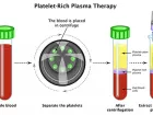PHƯƠNG PHÁP PRP HUYẾT TƯƠNG GIÀU TIỂU CẦU