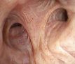 HD-image-right-upper-lobe_thumb-1