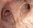 HD-image-right-upper-lobe_thumb-1