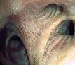 i-scan-2-image-right-upper-lobe-thumbnail