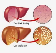 Những điều nên biết về bệnh gan nhiễm mỡ