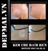 Bộ siêu kem che bạch biến cho mọi mầu da Super vitiligo  10gr Copy 04/04/2017 10:45:21