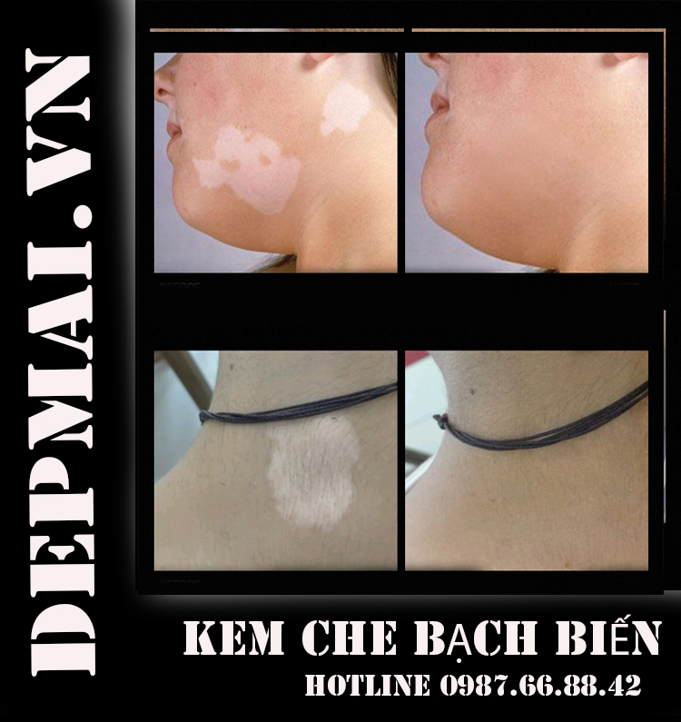 Bộ siêu kem che bạch biến cho mọi mầu da Super vitiligo  60 gr