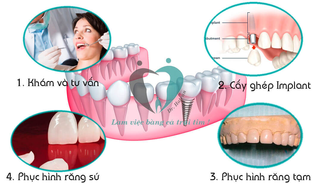 Quy trình cấy ghép Implant an toàn, hiệu quả tại Nha khoa Quốc tế Hà Nội Seoul