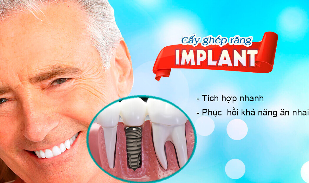 Tại sao bạn nên chọn Nha khoa Quốc tế Hà Nội Seoul để thực hiện cấy ghép Implant