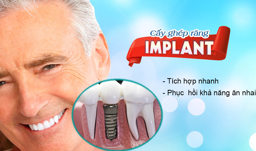 Implant là gì