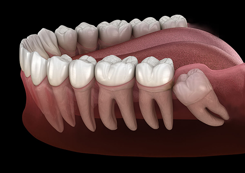 Hướng dẫn nhổ răng khôn