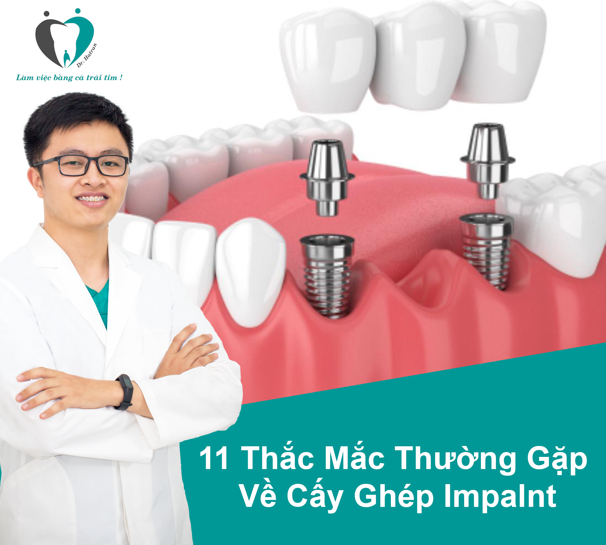 11 Thắc mắc thường gặp về cấy ghép Impalnt