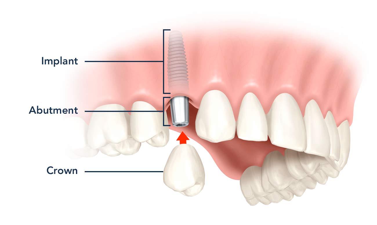 Trồng răng Implant là gì?