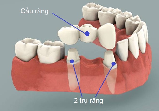 Có nên làm cầu răng không khi bị mất răng hàm?