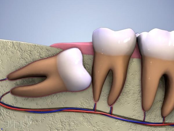 Giải đáp nhổ răng khôn hàm dưới có nguy hiểm không?