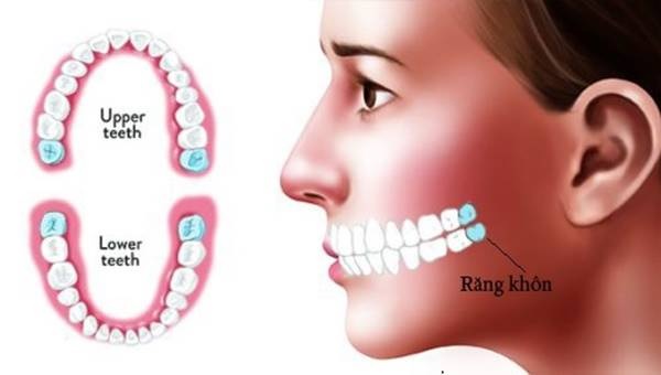 Răng khôn mọc ở vị trí nào và là răng số mấy?